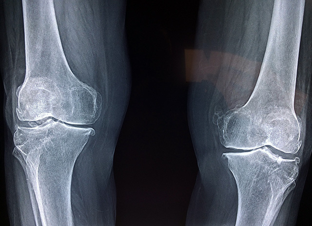 x-ray of the knees